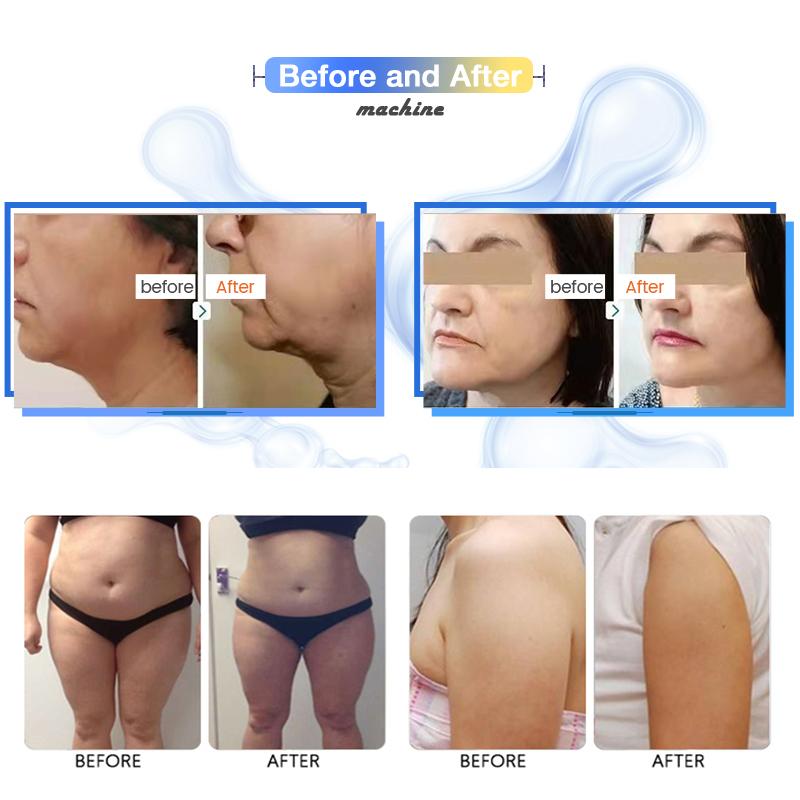 7D HIFU ihu na-ebuli ahụ slimming igwe (7)