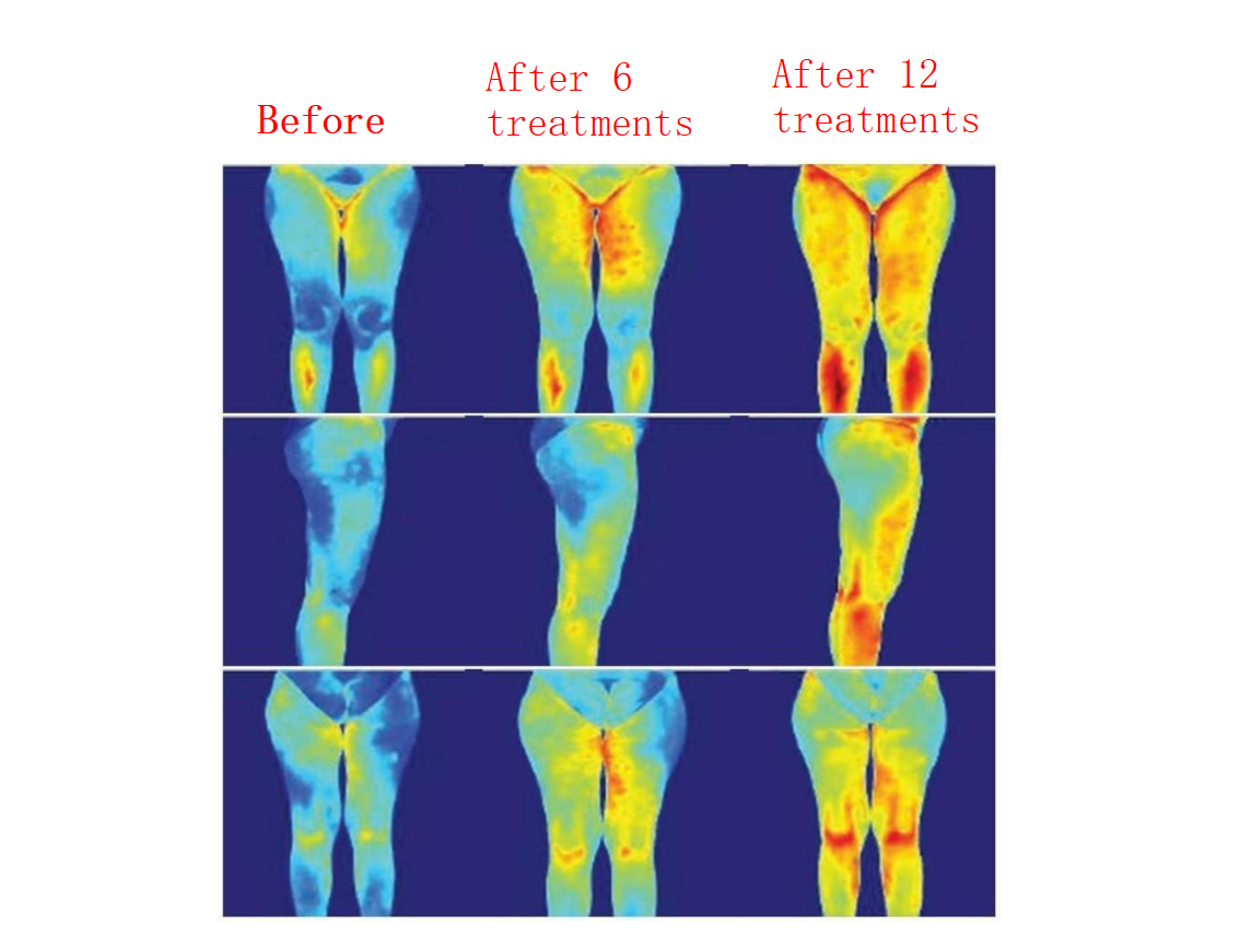 Indvendig kuglerulle krop slankende cellulite reduktion (5)